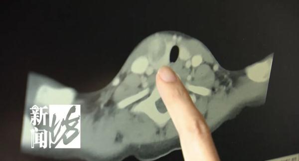 10岁孩子竟患癌！上海一医院两周3例，医生提醒：警惕这种症状→