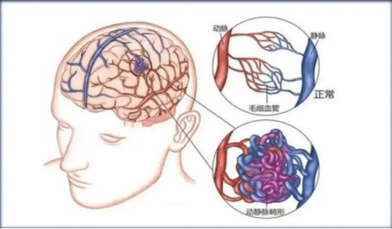 这个病“偏爱”年轻人！男子睡觉时突感剧烈头痛