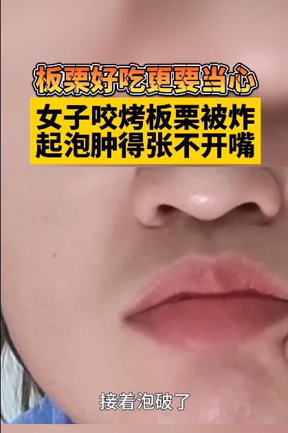 近期大量上市，宝妈吃了一个，嘴肿得张不开！