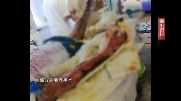 凌晨蚊香燃起被子，11岁男孩被重度烧伤