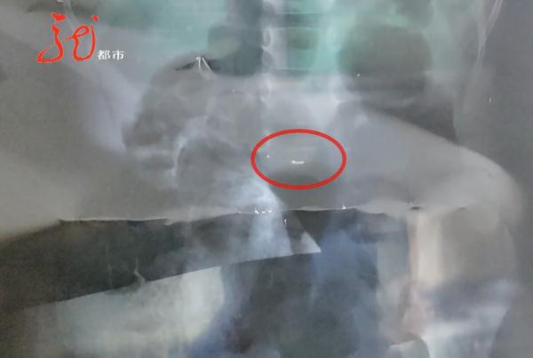 3岁女童误吞水银！家长心急如焚，紧急赶往哈尔滨！