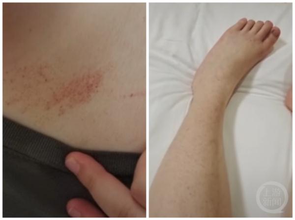 女大学生身上莫名出现红点和淤青,一查血小板为1 女大学生身上莫名出现红点和淤青,一查血小板为1