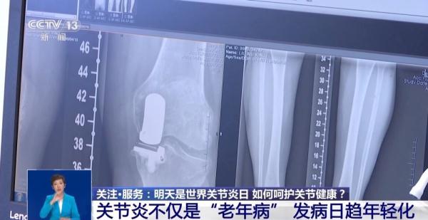 我国骨关节炎患者超1亿！怎样呵护你的关节健康？