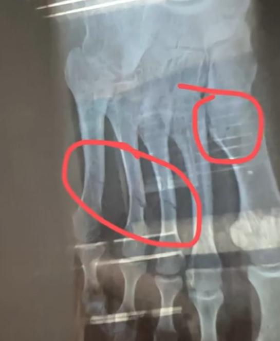 男子健身房失误砸断女生4根脚趾?!教练:这种失误在健身房经常发生…… 男子健身房失误砸断女生4根脚趾?!教练:这种失误在健身房经常发生……