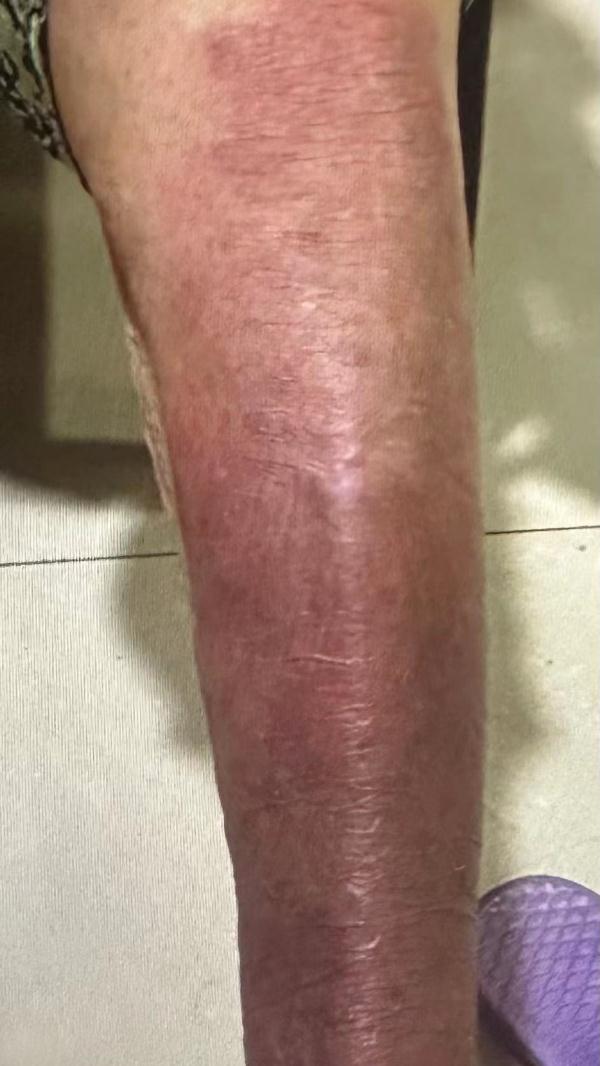 警惕毒蚊子!有人被叮咬染上丹毒,医生紧急提醒 警惕毒蚊子!有人被叮咬染上丹毒,医生紧急提醒