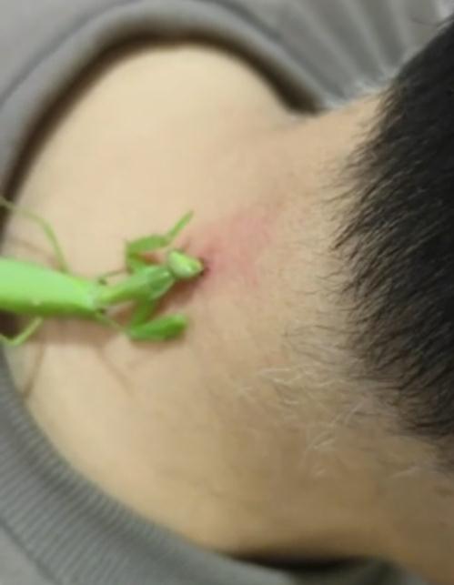 男子用螳螂吃掉长出的肉瘊子？医生：不科学，可能导致感染