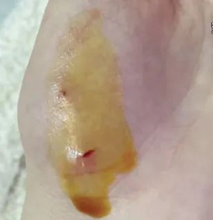 被猫抓伤用嘴吸毒？ 医生：这种做法不可取