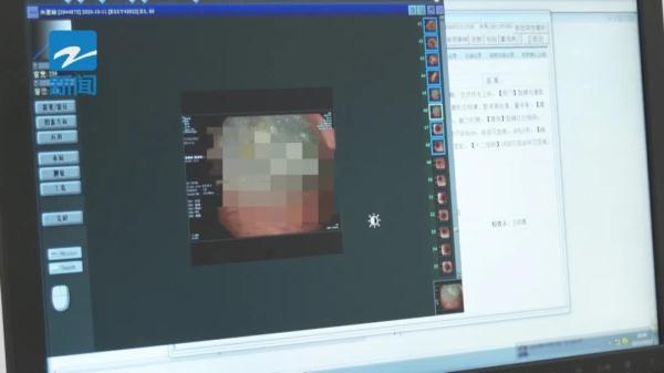 胃痛+吐血!老人吃了水果后胃里长出“乒乓球”,近期大量上市! 胃痛+吐血!老人吃了水果后胃里长出“乒乓球”,近期大量上市!