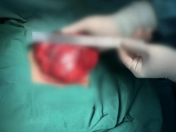 12岁女孩自闭了,竟是因为乳房1个月内突变“C罩杯”?医生:是肿瘤! 12岁女孩自闭了,竟是因为乳房1个月内突变“C罩杯”?医生:是肿瘤!