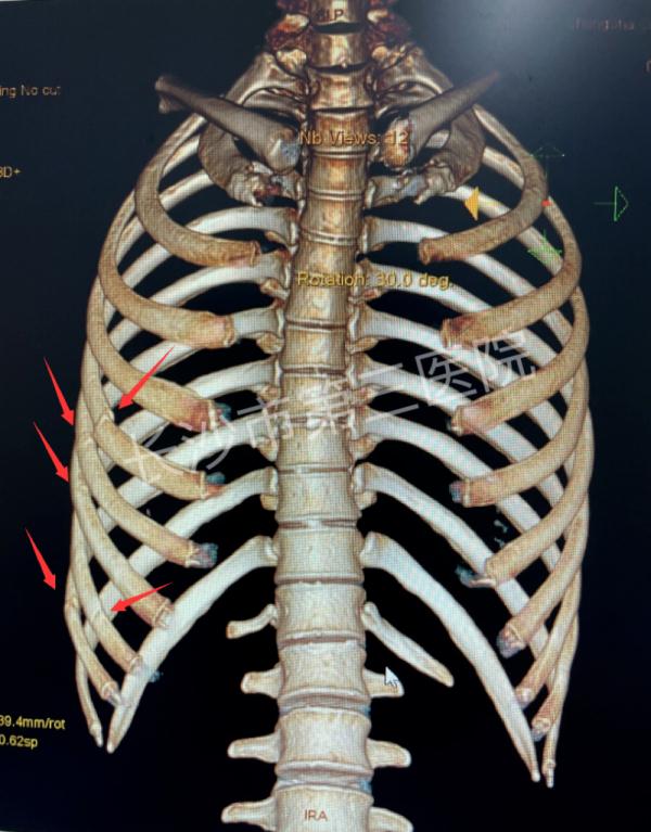 40岁女子一阵猛咳断了5根肋骨!这些习惯很多人都有