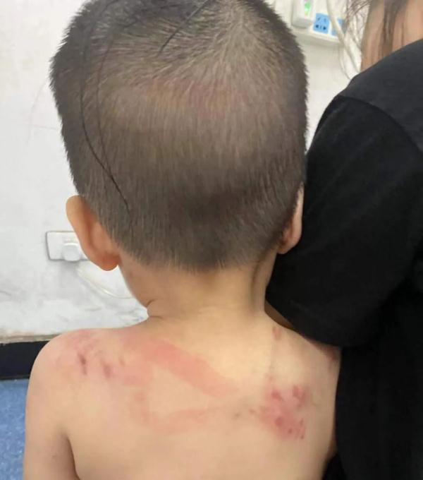 又一例！恶犬扑向1岁幼童，老人护娃险丧命！