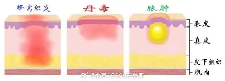 抠鼻挖耳要谨慎！可能会感染丹毒