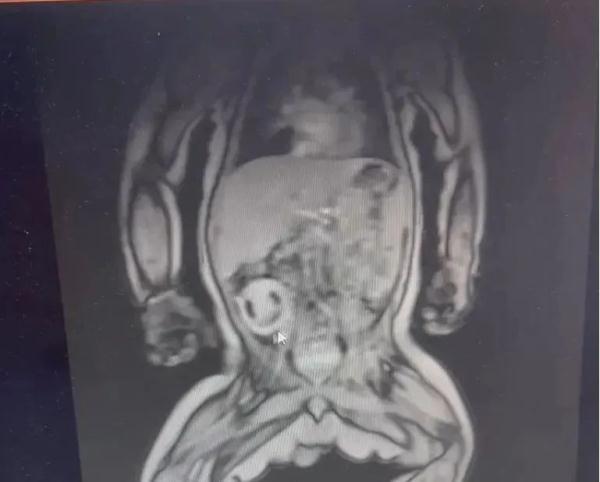 罕见寄生胎！4月大男婴睾丸内取出一个“娃”