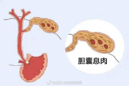 胆囊息肉b超图片图片