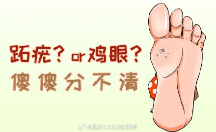 如何正确区分瘊子和鸡眼？
