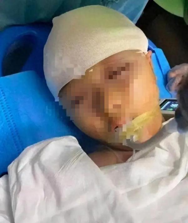 长沙被老师用尺打破头骨女孩已出院 长沙被老师用尺打破头骨女孩已出院