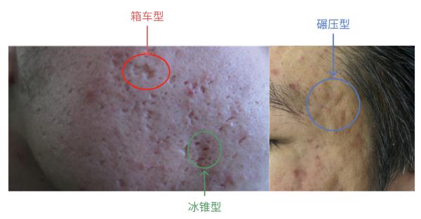 【健康资讯】如何预防痘坑产生？已经有痘坑了还能治疗吗？