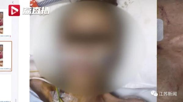 女子从200斤减到只剩50斤!身体所有器官都在出血... 女子从200斤减到只剩50斤!身体所有器官都在出血...