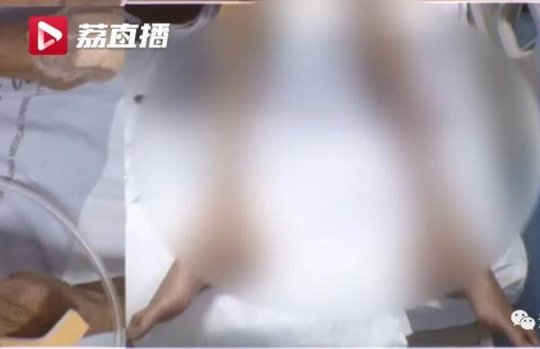 大连女孩从200斤减到仅剩50斤！垂危之际靠粪菌救了一命……