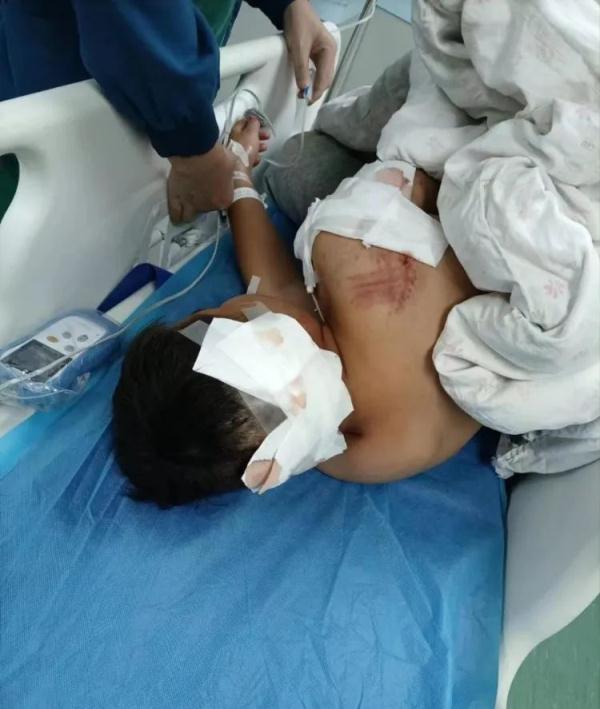 10岁男童遭阿拉斯加犬咬伤，事发第三天仍在ICU病房内救治