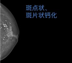 【实用知识】乳腺检查报告怎么看？这篇讲清楚了→