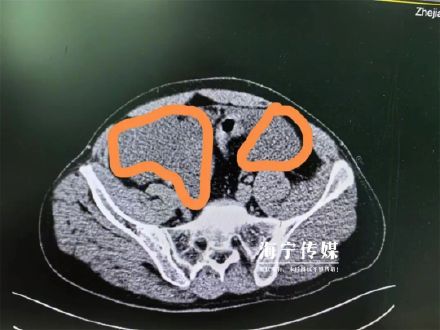 男子醉酒后摔一跤“摔爆”膀胱 医生:喝酒莫贪杯,更不要憋尿! 男子醉酒后摔一跤“摔爆”膀胱 医生:喝酒莫贪杯,更不要憋尿!