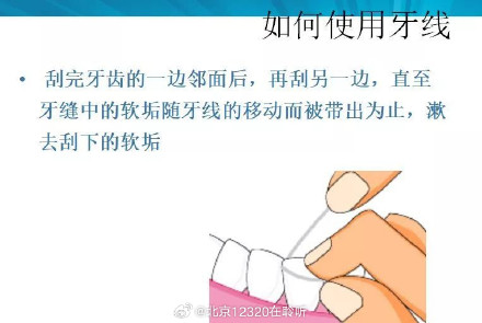 提倡选择牙线或牙间刷辅助清洁牙间隙