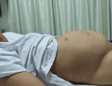 女学生被澡堂阿姨提醒肚子大得不正常,检查出20厘米畸胎瘤 女学生被澡堂阿姨提醒肚子大得不正常,检查出20厘米畸胎瘤