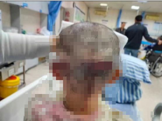 揪心!7岁女童遭恶犬撕咬重伤毁容,家属称狗主人至今未赔偿,家中积蓄已花光…… 揪心!7岁女童遭恶犬撕咬重伤毁容,家属称狗主人至今未赔偿,家中积蓄已花光……