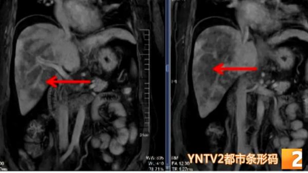 紧急提醒！最近昆明有医院已经连续接诊多例，这种东西太有迷惑性，千万不要吃！