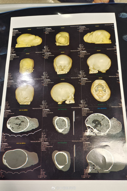 5岁男孩患超级罕见病，国内此前仅报道过1例