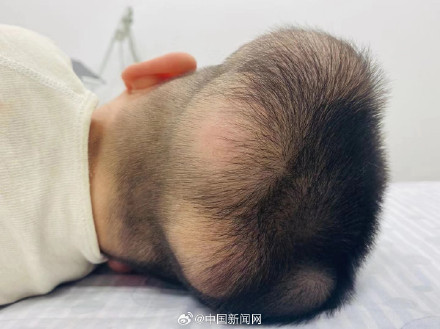 5岁男孩患超级罕见病，国内此前仅报道过1例