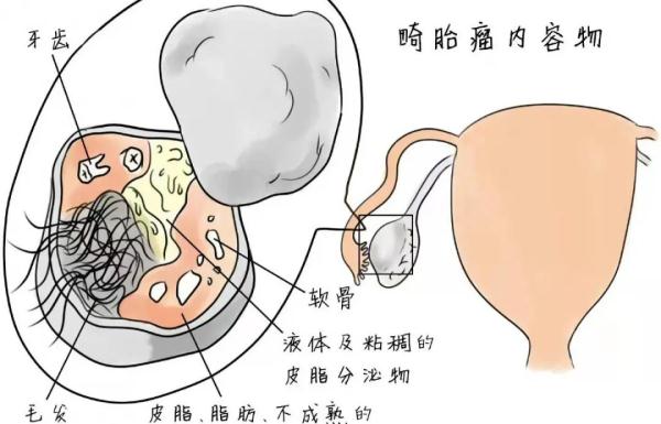 “肚子大”以为是胖，一查竟是瘤！肚子出现这些异常要重视→