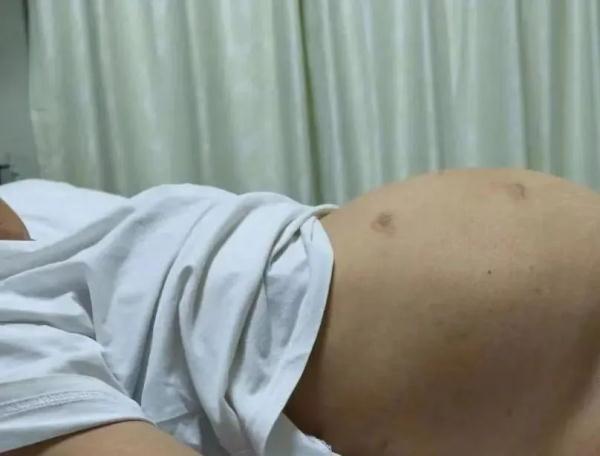 “肚子大”以为是胖，一查竟是瘤！肚子出现这些异常要重视→