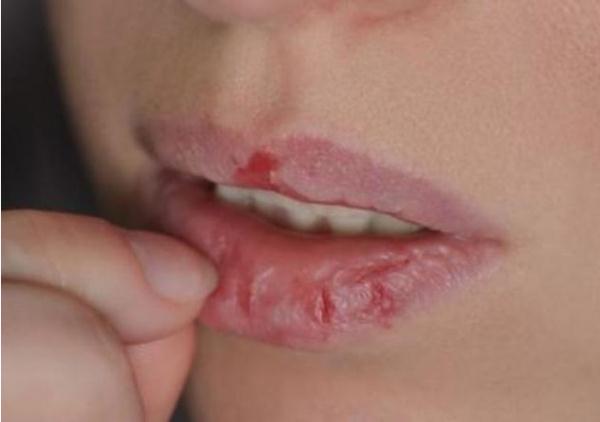 风寒物燥，嘴唇干裂、起皮儿怎么办？不能舔！