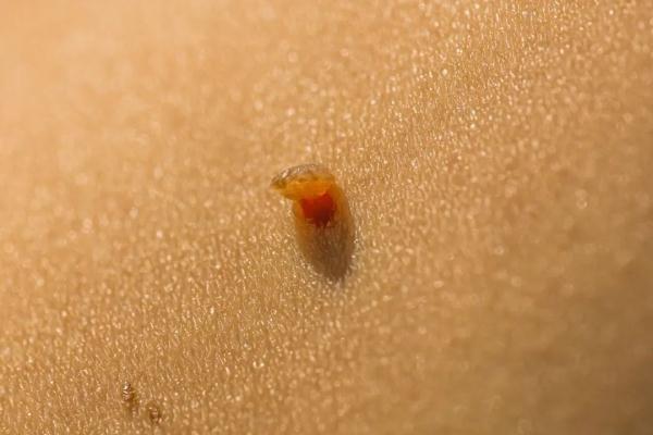 身上长“小疙瘩”?千万别乱抠!这三种可能是“大病”在预警! 身上长“小疙瘩”?千万别乱抠!这三种可能是“大病”在预警!