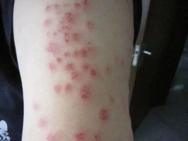 以人类血液为食，多国爆发！专家：传播快、难消灭