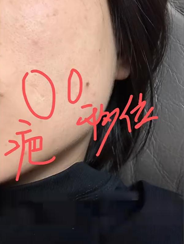 女子称被熊孩子打的铅弹留在脸上28年！