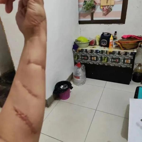 女子为保护室友被其前男友砍20多刀!“他们的冷漠让我寒心” 女子为保护室友被其前男友砍20多刀!“他们的冷漠让我寒心”