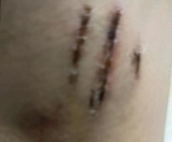 北京一男子遛狗未拴绳,致小孩大腿被咬伤!法院这样判→ 北京一男子遛狗未拴绳,致小孩大腿被咬伤!法院这样判→