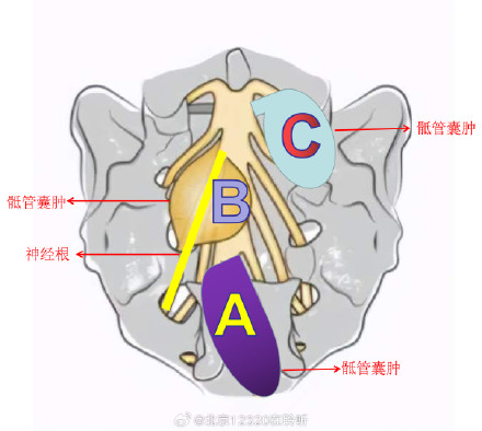如何区别是泌尿系感染还是骶管囊肿? 如何区别是泌尿系感染还是骶管囊肿?