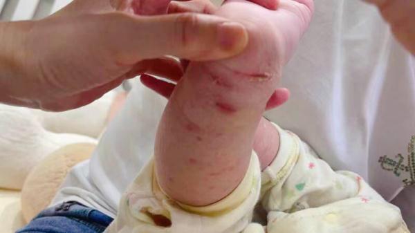 揪心！8个月大的宝宝全身满是红斑，伤痕累累，“真凶”竟是离他最近的......