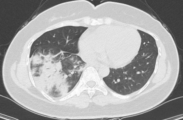 警惕!成年人咳嗽老不好,这种病不止孩子会感染→ 警惕!成年人咳嗽老不好,这种病不止孩子会感染→