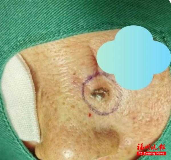 太吓人！脸上黑痣莫名出血，一查竟是癌
