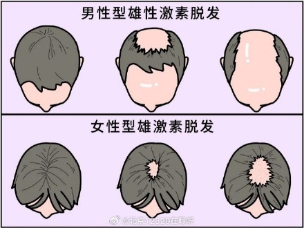 如何判断自己是不是病理性脱发？