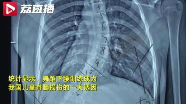 高度警惕！三周接诊5例，全是小孩！海南家长千万注意这事