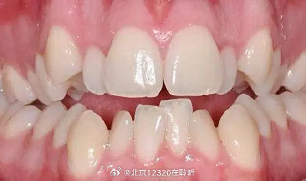 牙齿排列不齐应及时诊治