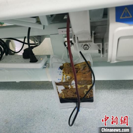 云南2男子误食毒菌致急性肝衰竭 医院创新引出毒胆汁成功救治 云南2男子误食毒菌致急性肝衰竭 医院创新引出毒胆汁成功救治