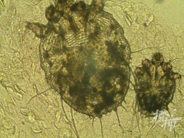 一家四口全中招!一到晚上痒到怀疑人生,“抓得满是血痕”,一查竟是…… 一家四口全中招!一到晚上痒到怀疑人生,“抓得满是血痕”,一查竟是……