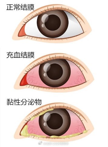 红眼病的症状有哪些？